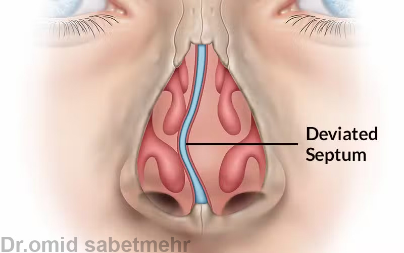 انحراف بینی و درمان آن